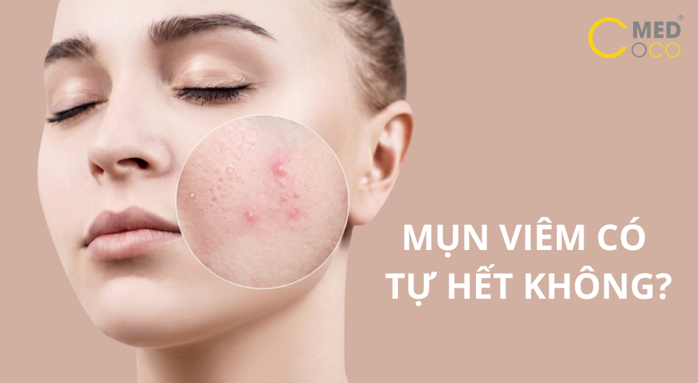 tìm hiểu về mụn viêm và cách điều trị