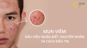 Mụn viêm nếu không điều trị và chăm sóc đúng cách sẽ có nguy cơ gây tổn thương sâu và để lại thâm, sẹo. 